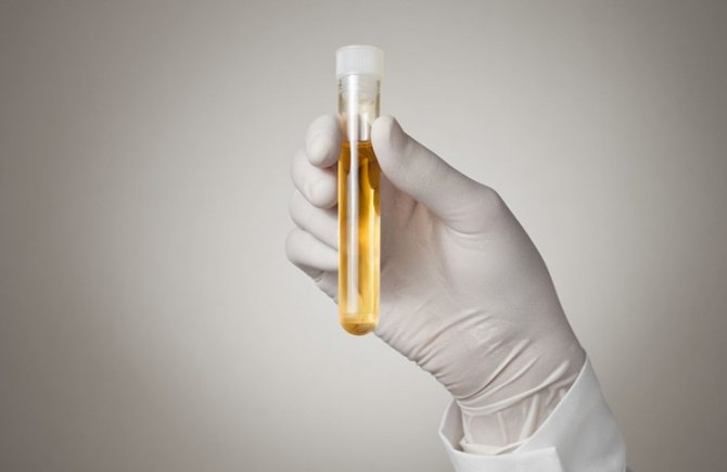 анализ мочи