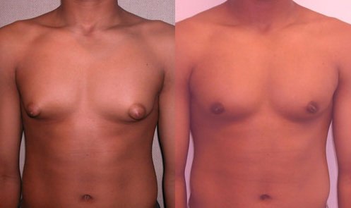 Гинекомастия