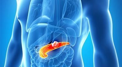 хронический панкреатит поджелудочной железы