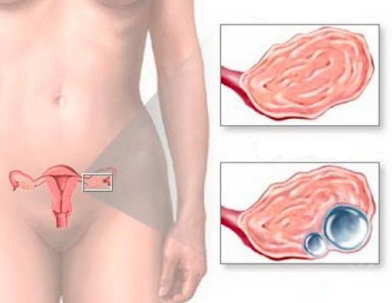 Как пить Дюфастон при кисте яичника