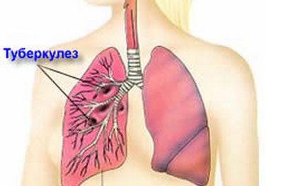 Локализация туберкулеза