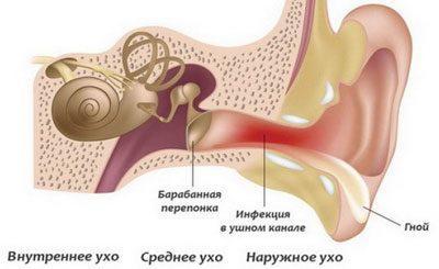 Наружный отит